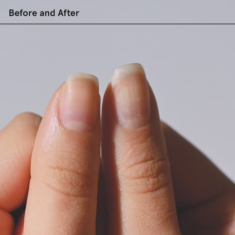 Vorher Nachher Nail Recovery Treatment